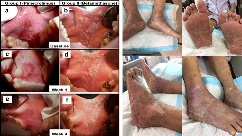 Biểu hiện lichen phẳng ở miệng với các vết loét