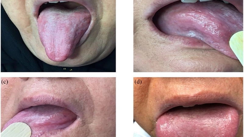 Tìm hiểu nguyên nhân bệnh lichen dưới góc độ y khoa