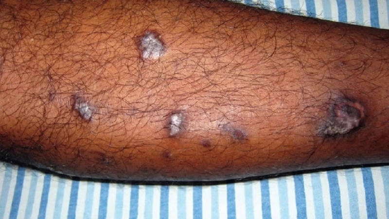 Hình ảnh bệnh lichen sẩn ngứa ở lòng bàn tay và bàn chân