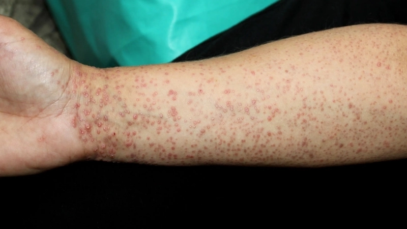 Hình ảnh bệnh lichen - Nhận biết sớm để điều trị hiệu quả