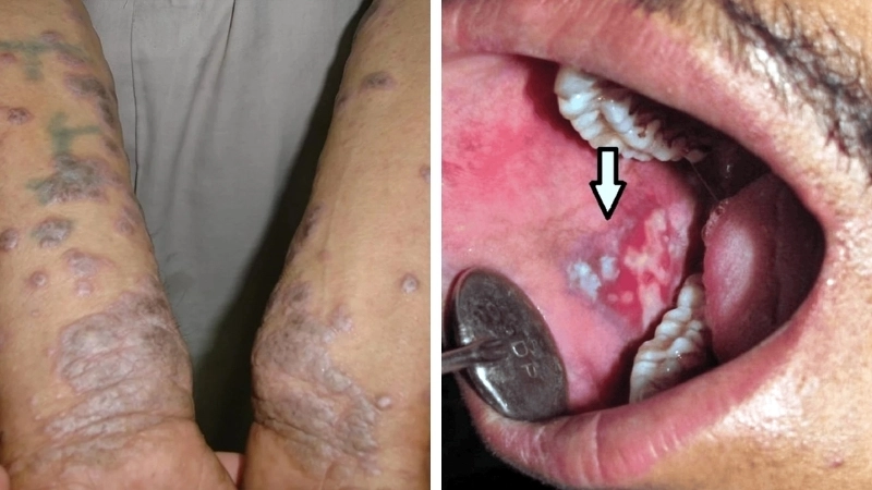 Cận cảnh tổn thương điển hình của bệnh lichen phẳng trên da.