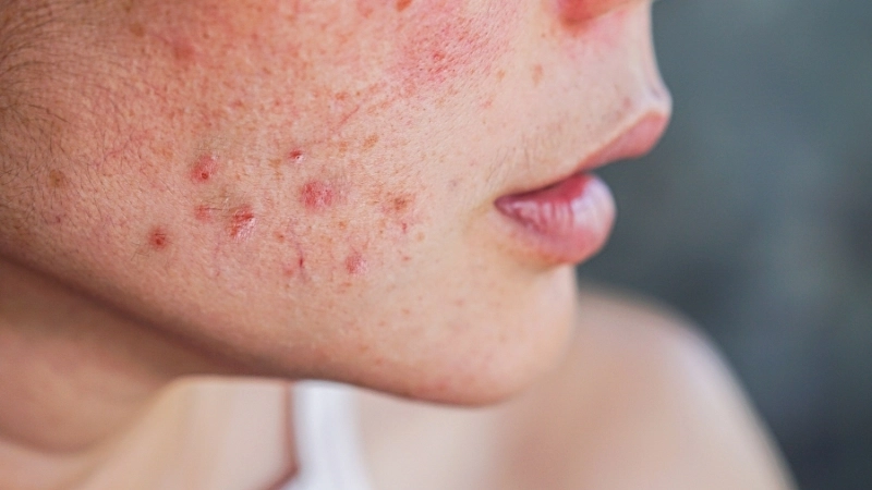 Cách trị mụn trứng cá hiệu quả tại nhà