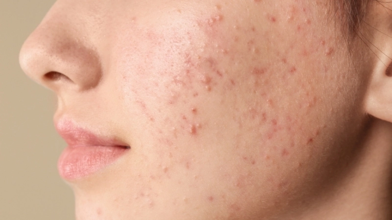 Nhận biết mụn ẩn khiến da sần sùi