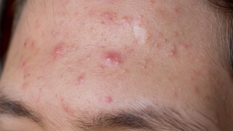 Biểu hiện của mụn nội tiết ở cằm và quai hàm