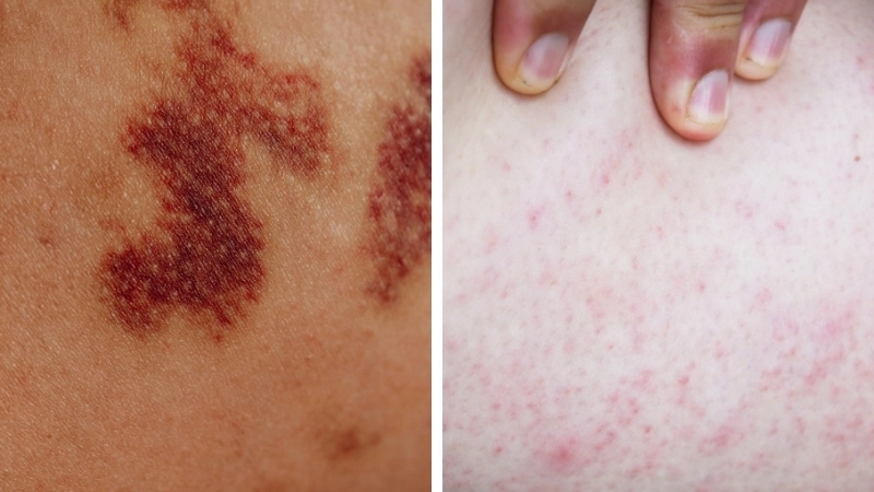 Biểu hiện của hình ảnh bệnh nấm tổ đỉa