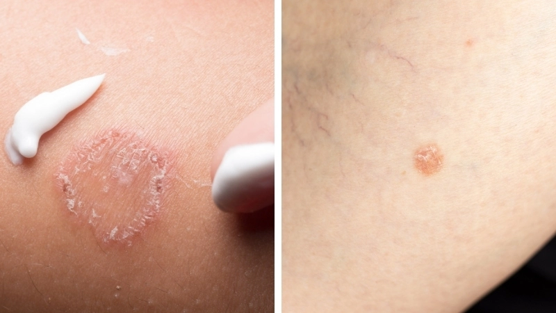 Nhận biết qua hình ảnh nấm móng chân