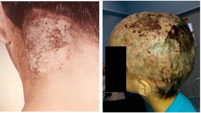 Các loại thuốc trị nấm da đầu dạng bôi và uống phổ biến