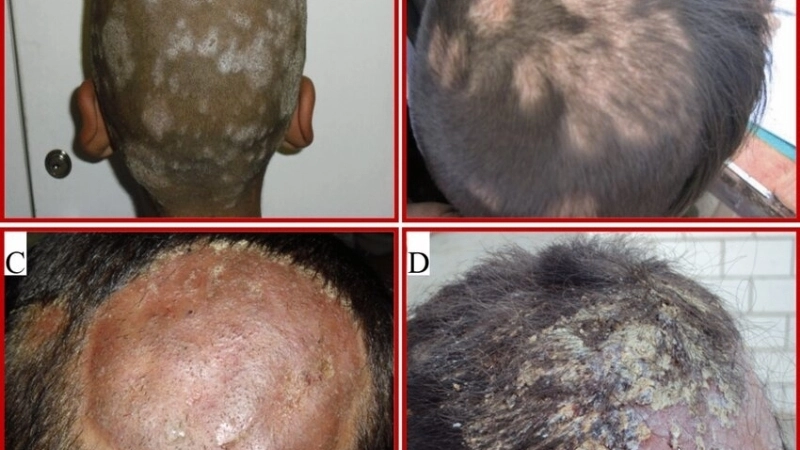 Sử dụng dầu gội trị nấm da đầu chuyên dụng theo chỉ định