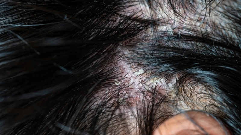 Phân biệt giữa nấm da đầu và gàu qua hình ảnh mảng bám