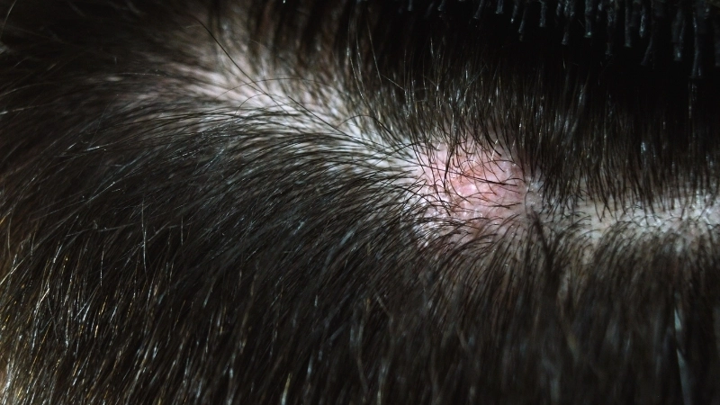 Hình ảnh bệnh nấm da đầu do chốc và do tóc hột gây ra