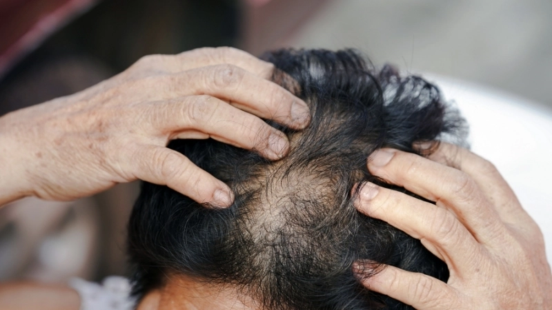 Môi trường da đầu ẩm ướt là một trong những nguyên nhân bị nấm da đầu hàng đầu.