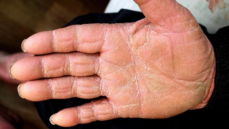Hiệu quả trước và sau khi áp dụng cách trị nấm da tay đúng phác đồ