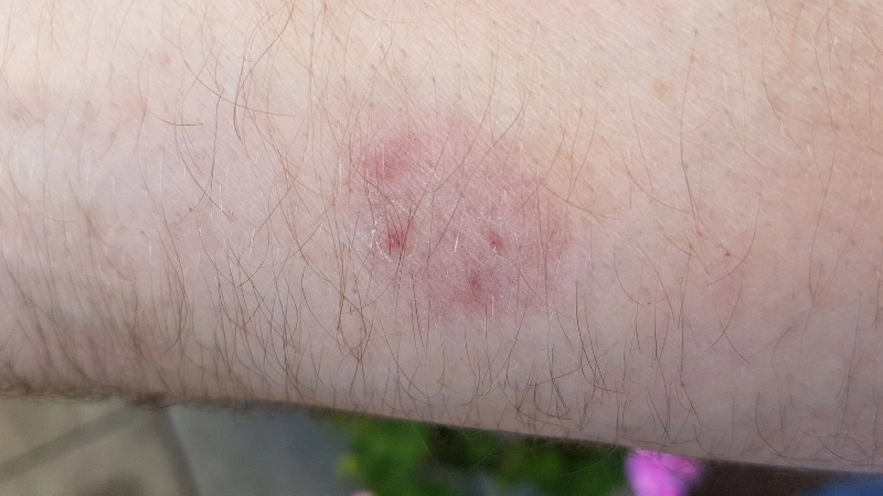 Hình ảnh bệnh nấm da - Nhận biết và phòng ngừa