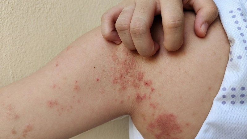 Cận cảnh vi khuẩn Hansen (Mycobacterium leprae), tác nhân chính gây ra bệnh phong.