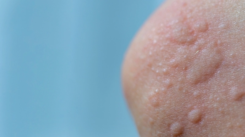 Minh họa cách chữa bệnh phong ngứa bằng phương pháp chườm mát