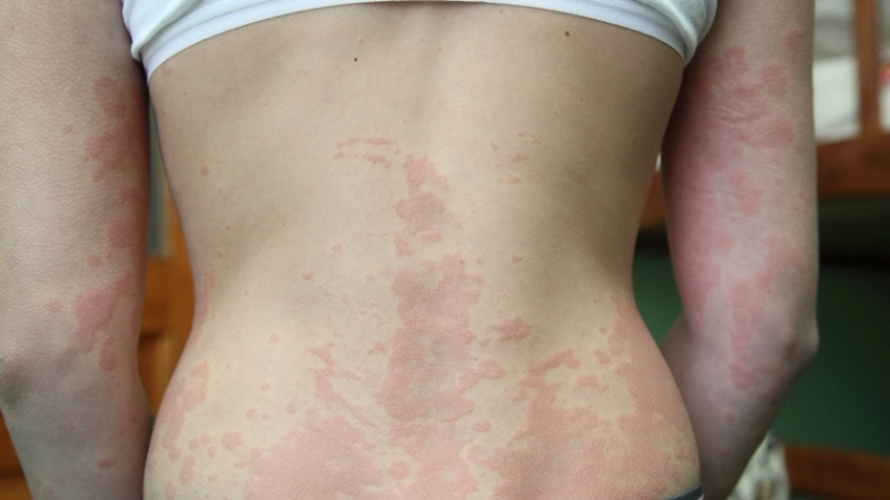 Các loại thuốc trị phong ngứa phổ biến được bác sĩ khuyên dùng