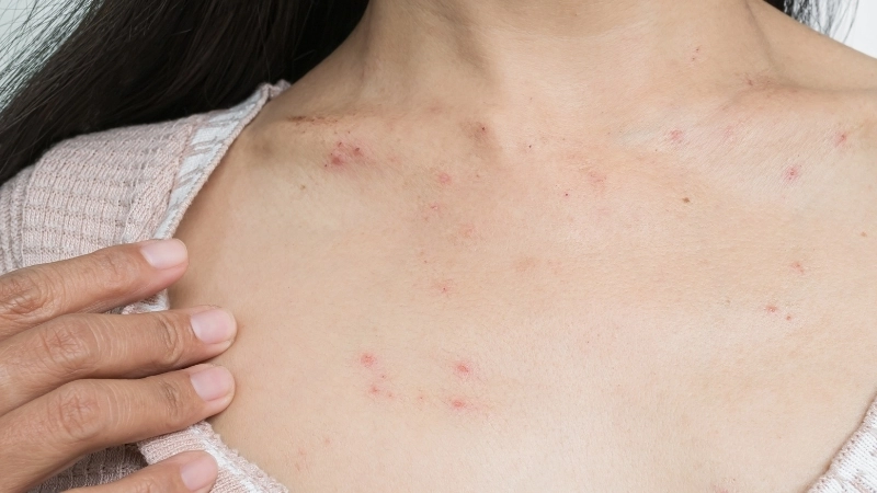 Lời khuyên khi bị phong ngứa kiêng ăn gì để tránh bùng phát