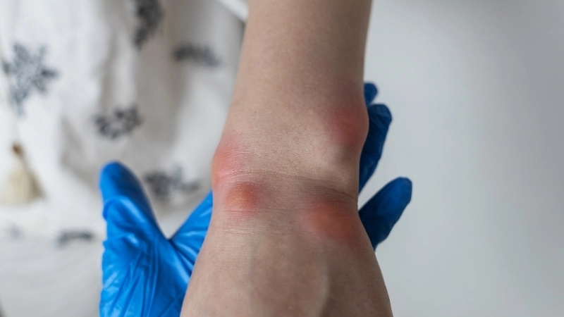 Phân tích nguyên nhân nổi mề đay do dị ứng thực phẩm