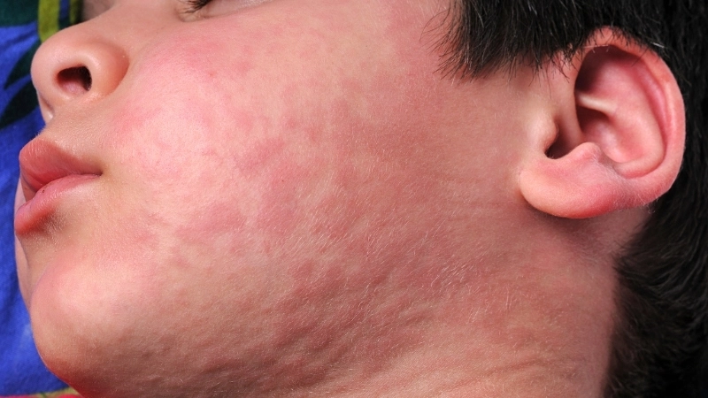 Hình ảnh bệnh phong ngứa - Nguyên nhân và cách điều trị