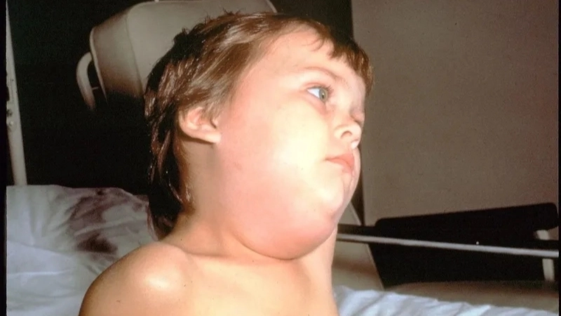 Minh họa cách chườm mát, một cách chữa bệnh quai bị tại nhà