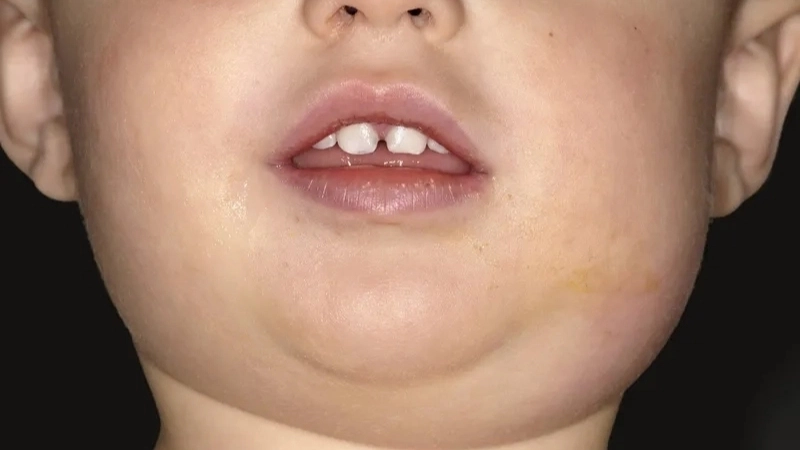 Hình ảnh các món ăn chua cay mà bệnh quai bị kiêng gì