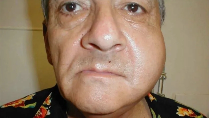 Vùng sưng đau do bệnh quai bị ở nam giới