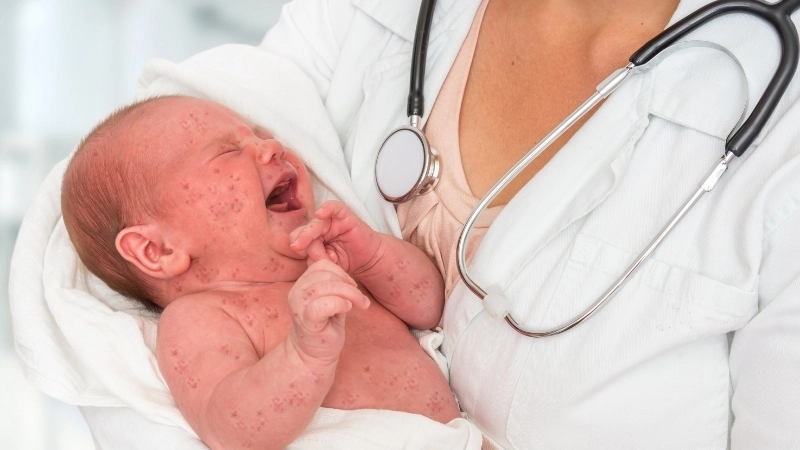 Cách phân biệt sởi và rubella qua nốt ban