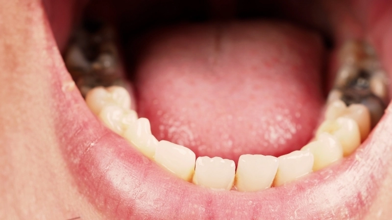 Tìm hiểu làm sao để hết đau răng nhanh chóng