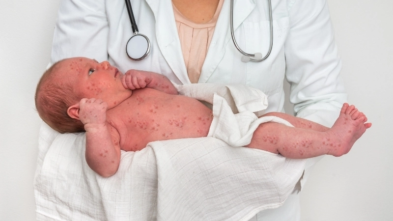 Giải đáp thắc mắc bệnh sởi có lây không qua đường tiếp xúc