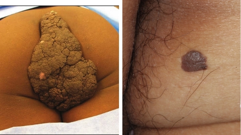 So sánh bệnh sùi mào gà hình ảnh nhiệt lưỡi