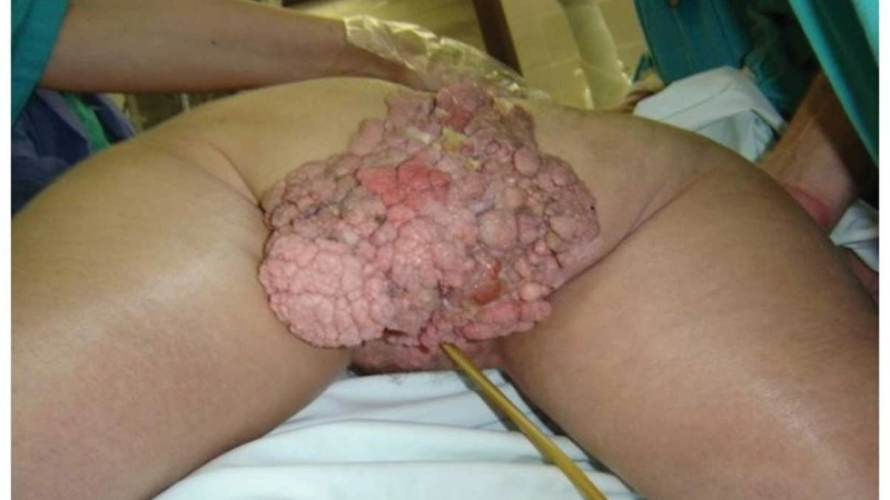 Tình trạng bệnh sùi mào gà hình ảnh nổi mụn ở vùng kín nữ