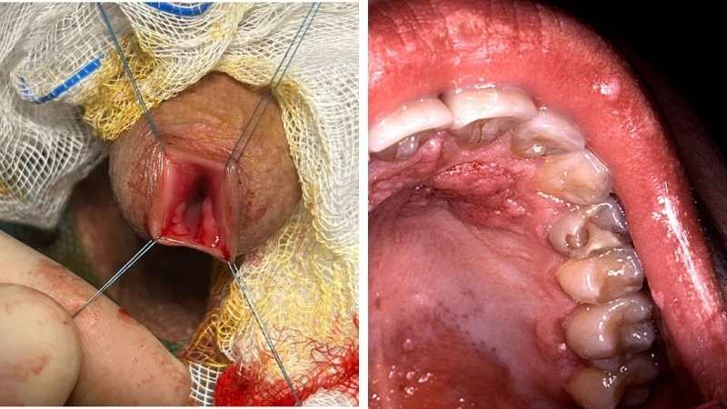 Dấu hiệu bệnh sùi mào gà ở nam hình ảnh chi tiết