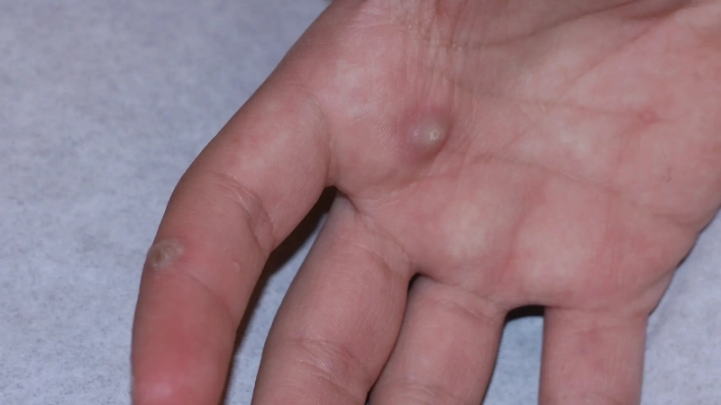 Bệnh sùi mào gà tiếng anh là gì? Genital Warts