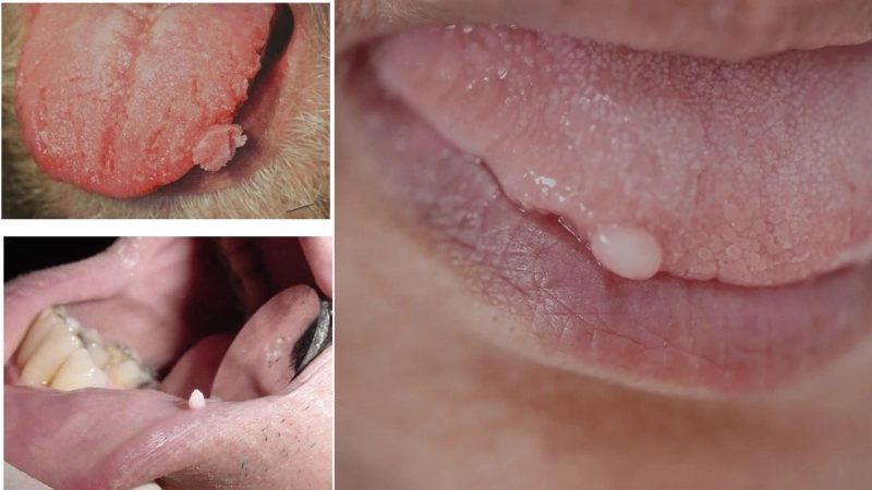 Hình ảnh bệnh sùi mào gà giai đoạn đầu ở nam giới