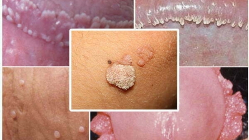 Hình ảnh bệnh sùi mào gà - Dấu hiệu nhận biết sớm