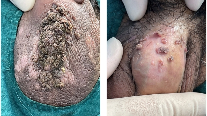 Các nốt sùi trong hình ảnh bệnh sùi mào gà ở miệng