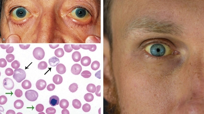 Thông tin về chi phí xét nghiệm Thalassemia hiện nay