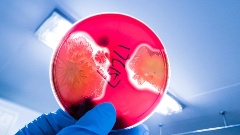 Hình ảnh bệnh tan máu bẩm sinh - Dấu hiệu vàng da