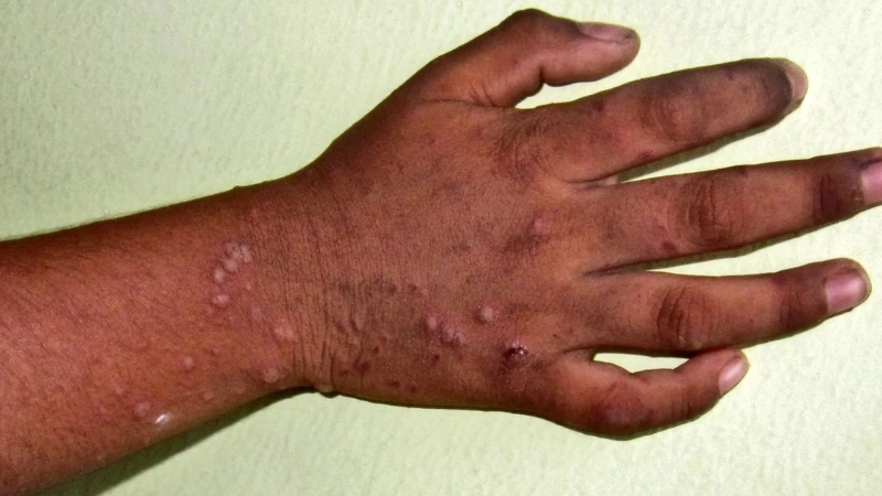 Hình ảnh bệnh tay chân miệng cấp độ 1 - Dấu hiệu nhận biết