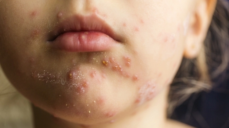 Cận cảnh hình ảnh bị thuỷ đậu ở người lớn