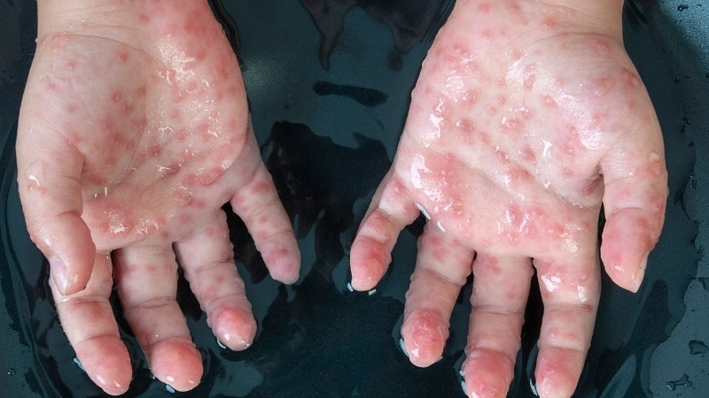 Cảnh báo hình ảnh thuỷ đậu bị bội nhiễm có mủ