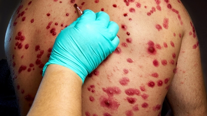 Tổng quan hình ảnh bệnh thủy đậu trên da