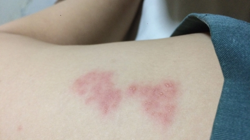 Hình ảnh bệnh thủy đậu ở người lớn qua từng giai đoạn