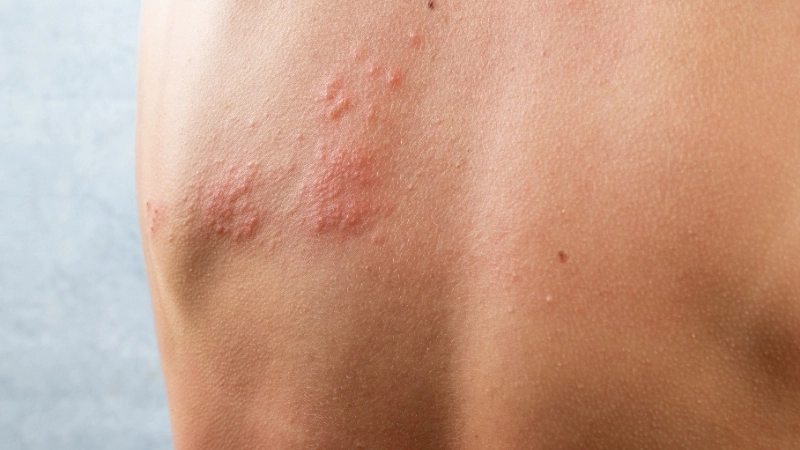 Hình ảnh phân biệt trái rạ và sởi qua hình thái ban