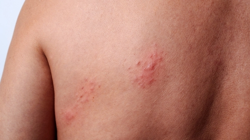 Các nốt trái rạ điển hình trên da, cần được chăm sóc đúng cách để tránh nhiễm trùng và để lại sẹo.