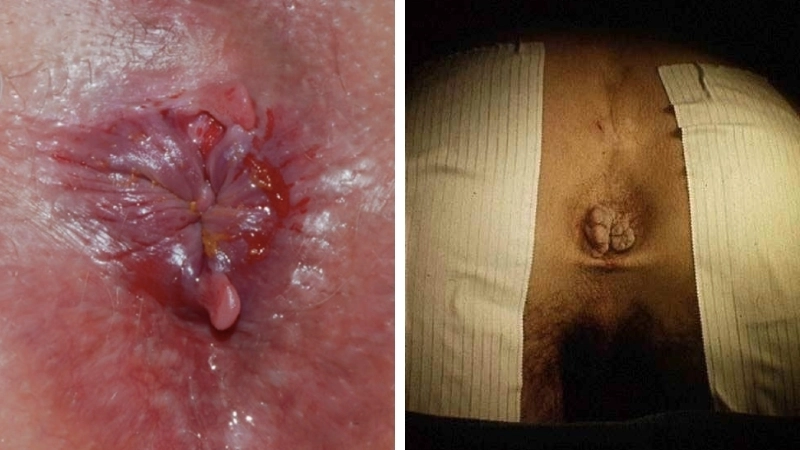 Dấu hiệu khi xem hình ảnh bị bệnh trĩ