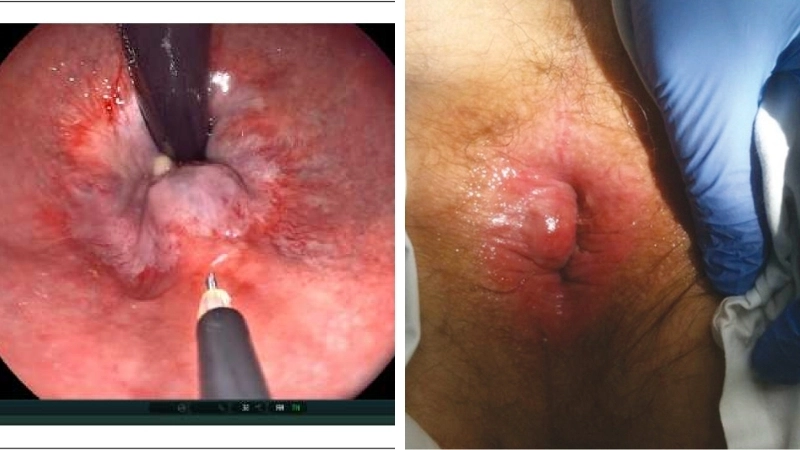 Biểu hiện qua hình ảnh bệnh trĩ ở phụ nữ mang thai