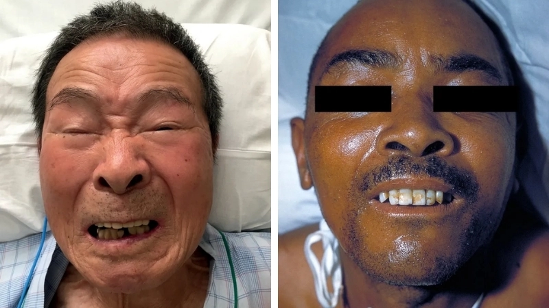 Hình ảnh trực khuẩn uốn ván dưới kính hiển vi