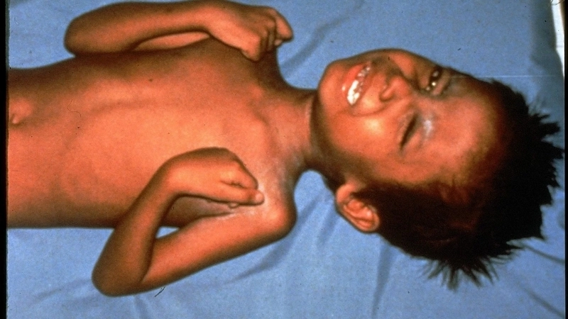 Cách xử lý khi bị đinh rỉ sét đâm có sao không