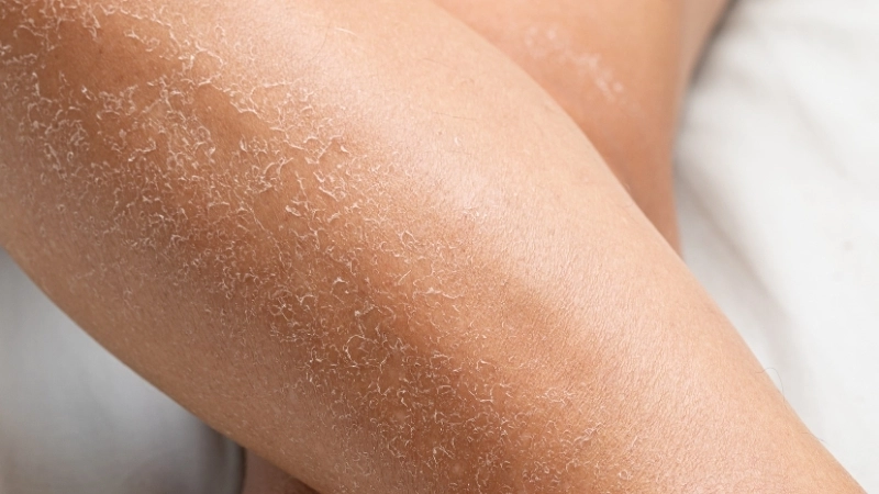 Album ảnh phân biệt bệnh vảy cá và bệnh chàm khô